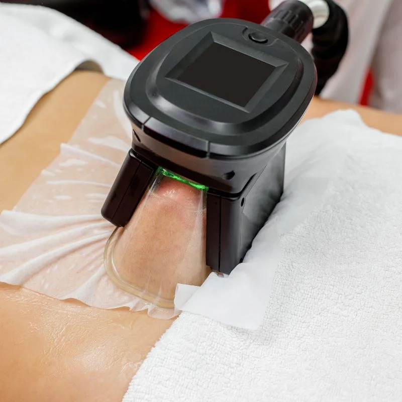 Fat Freezing treatment Ladymoor